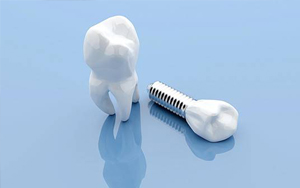 dental crown with implant