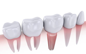 dental implant illustration