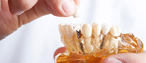 Dental implant model