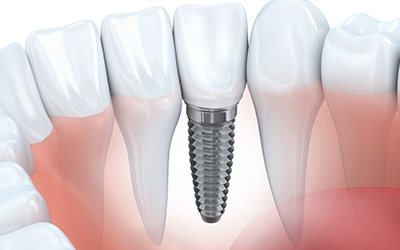 Animation of implant supported crown