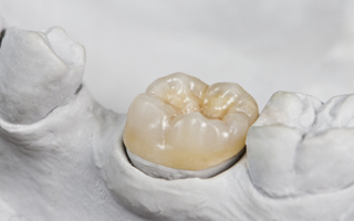 Model tooth with an all-ceramic crown