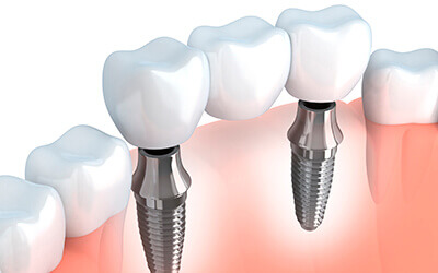 dental implants supporting dental bridge